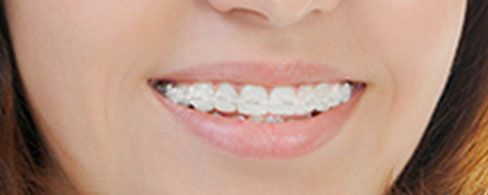 The Difference Between Clear Braces and Clear Aligners